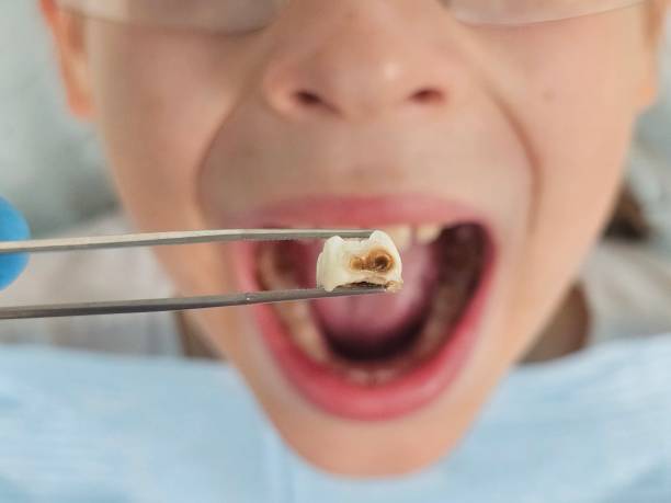 Best Emergency Broken Tooth Repair in Brandon, FL